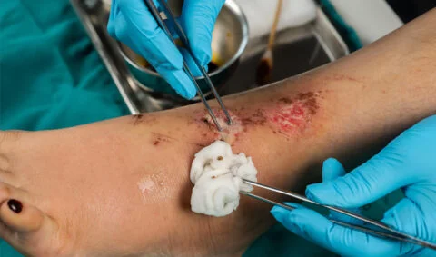 Wound Care - hands in blue gloves using tweezers and a swab to clean foot wound