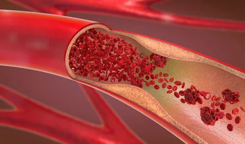 Venous Thromboembllism